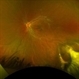 Ocular Toxocariasis Ocular Toxocariasis