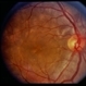 Vogt-Koyanagi-Harada Disease Vogt-Koyanagi-Harada Disease