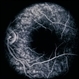 Solar Retinopathy / Familial Solar Retinopathy / Familial