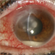 Corneal Ulcer