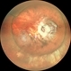 Status Post Scleral Buckling Status Post Scleral Buckling