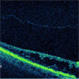 Retinoschisis with Outer Layer Break Retinoschisis with Outer Layer Break
