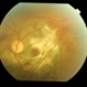 Traumatic Optic Neuropathy With Macular Scar