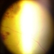 Coats' Disease with NVI Coats' Disease with NVI