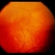 Subretinal Fibrosis Subretinal Fibrosis