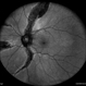 Pigmented Paravenous Retinochoroidal Atrophy Pigmented Paravenous Retinochoroidal Atrophy