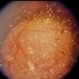 Choroidal Melanoma With Vitreous Seeding Choroidal Melanoma With Vitreous Seeding