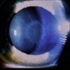 Wilson's Disease Wilson's Disease