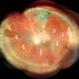 Familial Exudative Vitreo-retinopathy Familial Exudative Vitreo-retinopathy