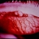 Multiple Endrocrine Neoplasia