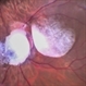 Triamcinolone Stained Hyaloid Triamcinolone Stained Hyaloid