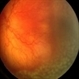 Aggressive Posterior ROP With Laser Aggressive Posterior ROP With Laser