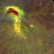Proliferative Diabetic Retinopathy Proliferative Diabetic Retinopathy