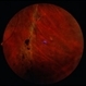 Angioma from Chronic Retinal Detachment Angioma from Chronic Retinal Detachment