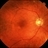 Cancer-Associated Retinopathy (CAR) - Retina Image Bank