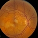 Multiple Acute Embolic Branch Retinal Artery Occlusions