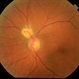 Retinal Astrocytoma Retinal Astrocytoma