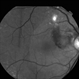 Polypoidal Choroidal Vasculopathy