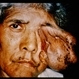Facial Neurofibroma Facial Neurofibroma