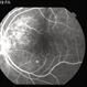 Choroidal Hemangioma Choroidal Hemangioma