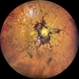 Idiopathic Intracranial Hypertension Idiopathic Intracranial Hypertension