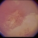 Coat's Disease Coat's Disease