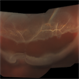 Giant Retinal Tear