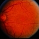 Macular Hole Evolving / Lamellar Hole Macular Hole Evolving / Lamellar Hole