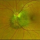 Combined Hamartoma of Retina and Retinal Pigment Epithelium