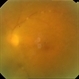 Candida Endophthalmitis