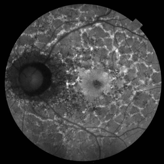 Reticular Pattern Dystrophy - Retina Image Bank