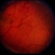 Retinal Capillary Hemangioblastoma Retinal Capillary Hemangioblastoma