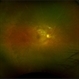 IRVAN Syndrome