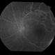 BRVO With Non-perfusion