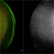 Retinal Macroaneurysm (Left Eye) Retinal Macroaneurysm (Left Eye)