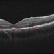 05- Unilateral Acute Idiopathic Maculopathy (UAIM) - OCT OD 05- Unilateral Acute Idiopathic Maculopathy (UAIM) - OCT OD
