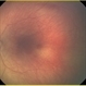 Premature Retina With No ROP