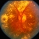 CNVM / Cholesterolemia
