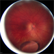 Ectopia Lentis et Pupillae