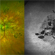 Severe macular atrophy secondary to Pseudoxanthoma Elasticum and CNV Severe macular atrophy secondary to Pseudoxanthoma Elasticum and CNV