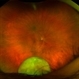 Traumatic Dislocation of the Crystalline Lens Traumatic Dislocation of the Crystalline Lens