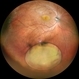 Traumatic Lens Drop in Vitreous Traumatic Lens Drop in Vitreous