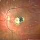 Macular Telangiectasia Type 2 Macular Telangiectasia Type 2