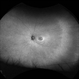 Hydroxychloroquine Maculopathy Hydroxychloroquine Maculopathy