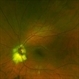 Choroidal Osteoma Associated to Myelinated Nerve Fibers Choroidal Osteoma Associated to Myelinated Nerve Fibers