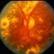 CNVM / Cholesterolemia