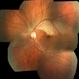 Branch Retinal Artery Occlusion With Calcium Embolus at the Disc - Fundus  Photo Branch Retinal Artery Occlusion With Calcium Embolus at the Disc - Fundus  Photo