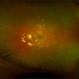 IRVAN Syndrome