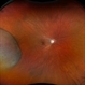 New Choroidal Melanoma with Exudative Detachment New Choroidal Melanoma with Exudative Detachment