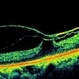 Macular Traction in  PDR Macular Traction in  PDR